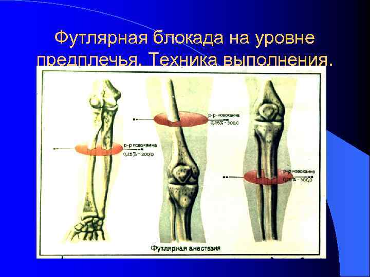 Футлярная блокада на уровне предплечья. Техника выполнения. 