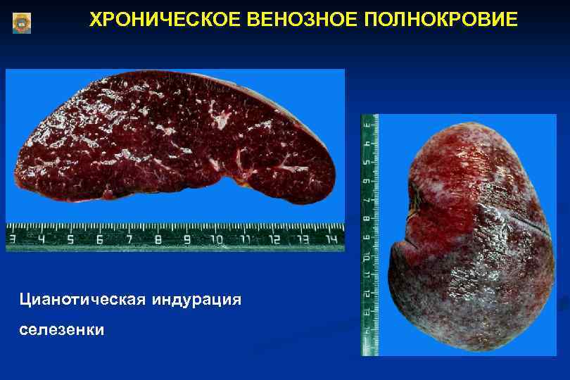  ХРОНИЧЕСКОЕ ВЕНОЗНОЕ ПОЛНОКРОВИЕ Цианотическая индурация селезенки 