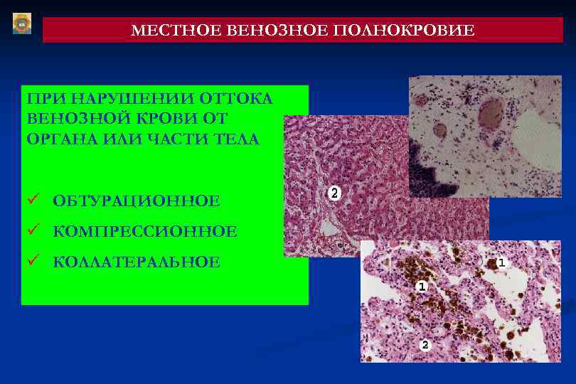  МЕСТНОЕ ВЕНОЗНОЕ ПОЛНОКРОВИЕ ПРИ НАРУШЕНИИ ОТТОКА ВЕНОЗНОЙ КРОВИ ОТ ОРГАНА ИЛИ ЧАСТИ ТЕЛА