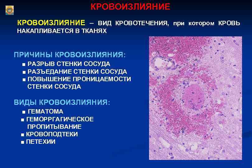  КРОВОИЗЛИЯНИЕ – ВИД КРОВОТЕЧЕНИЯ, при котором КРОВЬ НАКАПЛИВАЕТСЯ В ТКАНЯХ ПРИЧИНЫ КРОВОИЗЛИЯНИЯ: ■