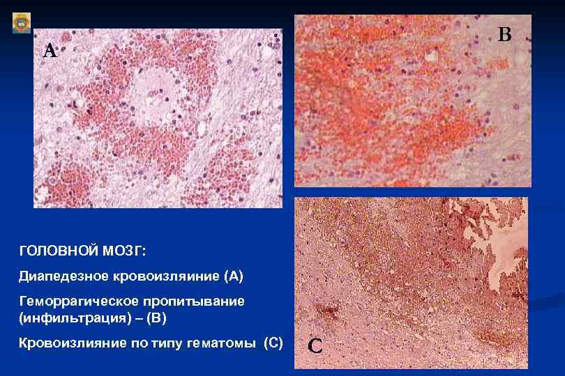  В А ГОЛОВНОЙ МОЗГ: Диапедезное кровоизляиние (А) Геморрагическое пропитывание (инфильтрация) – (В) Кровоизлияние