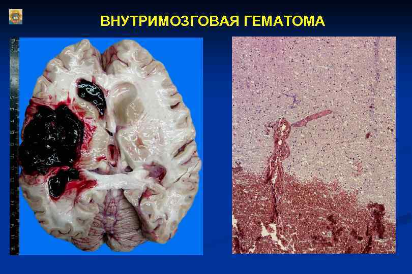 ВНУТРИМОЗГОВАЯ ГЕМАТОМА 