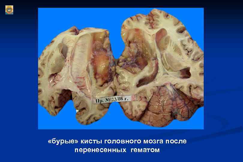  «бурые» кисты головного мозга после перенесенных гематом 