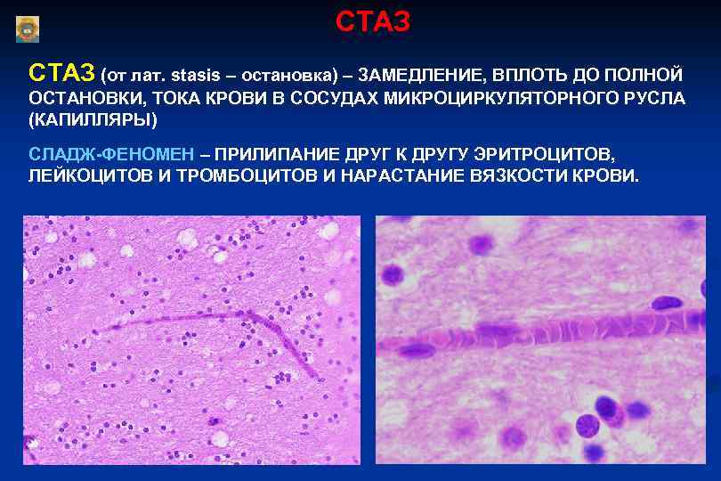  СТАЗ (от лат. stasis – остановка) – ЗАМЕДЛЕНИЕ, ВПЛОТЬ ДО ПОЛНОЙ ОСТАНОВКИ, ТОКА