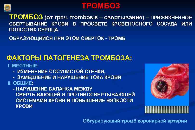  ТРОМБОЗ (от греч. trombosis – свертывание) – ПРИЖИЗНЕННОЕ СВЕРТЫВАНИЕ КРОВИ В ПРОСВЕТЕ КРОВЕНОСНОГО