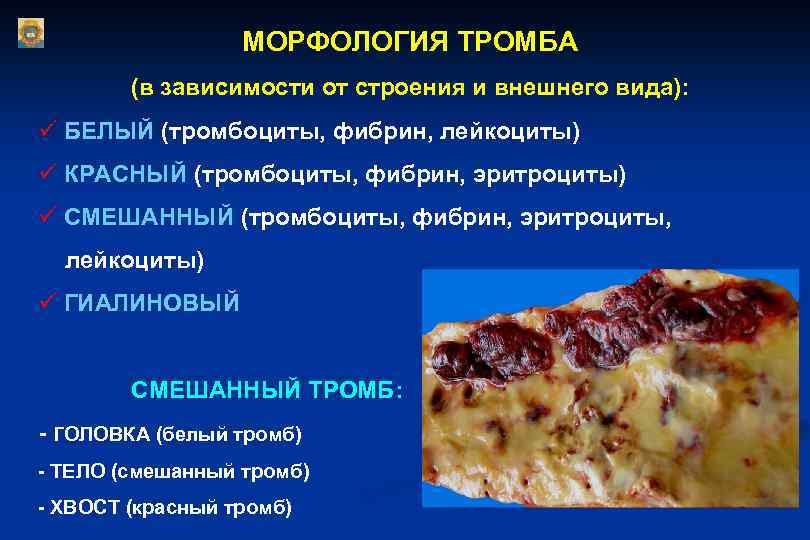  МОРФОЛОГИЯ ТРОМБА (в зависимости от строения и внешнего вида): ü БЕЛЫЙ (тромбоциты, фибрин,