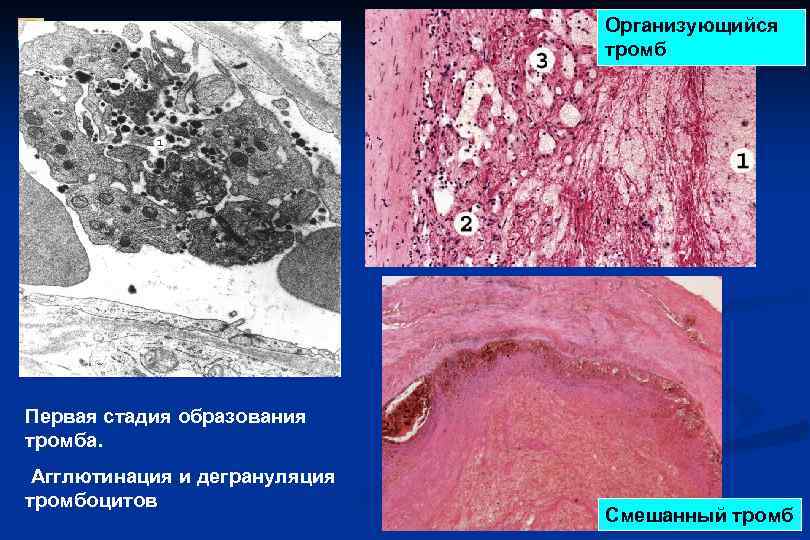  Организующийся тромб Первая стадия образования тромба. Агглютинация и дегрануляция тромбоцитов Смешанный тромб 