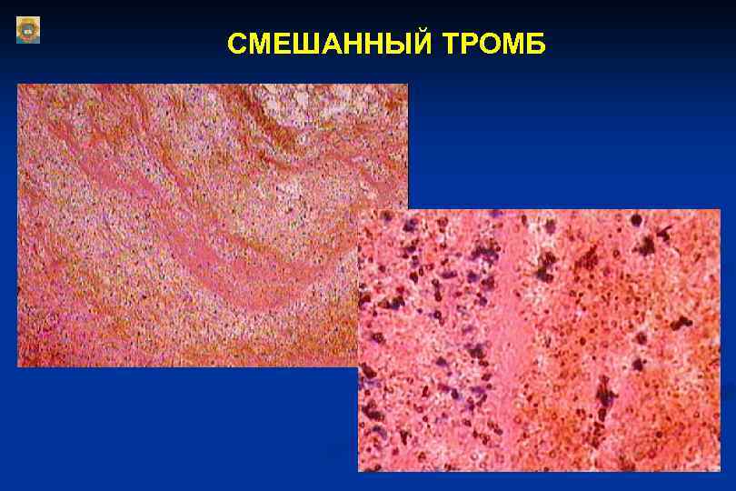Строение тромба. Смешанный тромб микропрепарат патанатомия. Красный тромб микропрепарат. Смешанный тромб в Вене микропрепарат. Красный тромб в Вене микропрепарат.