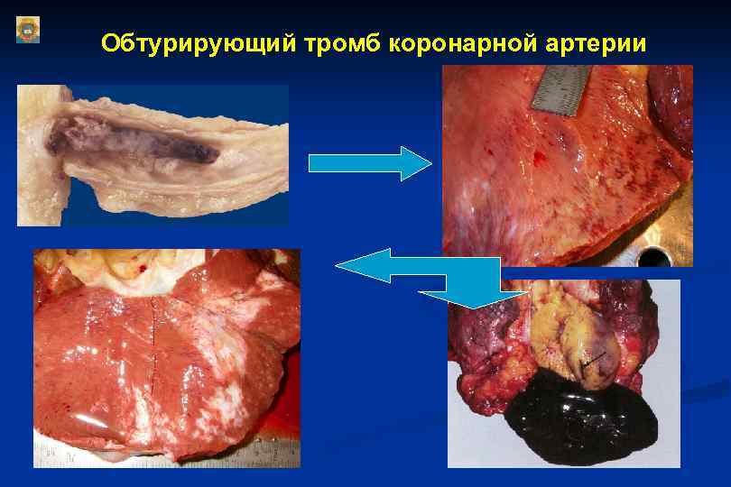 Обтурирующий тромб коронарной артерии 