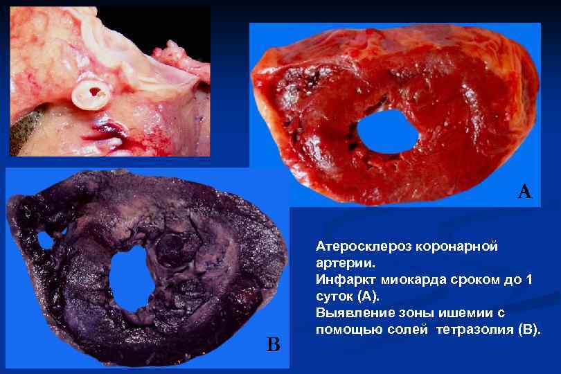  А Атеросклероз коронарной артерии. Инфаркт миокарда сроком до 1 суток (А). Выявление зоны