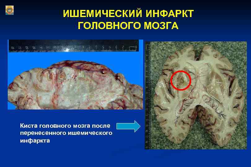  ИШЕМИЧЕСКИЙ ИНФАРКТ ГОЛОВНОГО МОЗГА Киста головного мозга после перенесенного ишемического инфаркта 