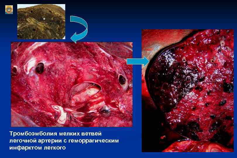 Тромбоэмболия мелких ветвей легочной артерии с геморрагическим инфарктом легкого 