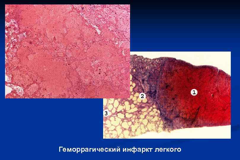 Геморрагический инфаркт легкого 