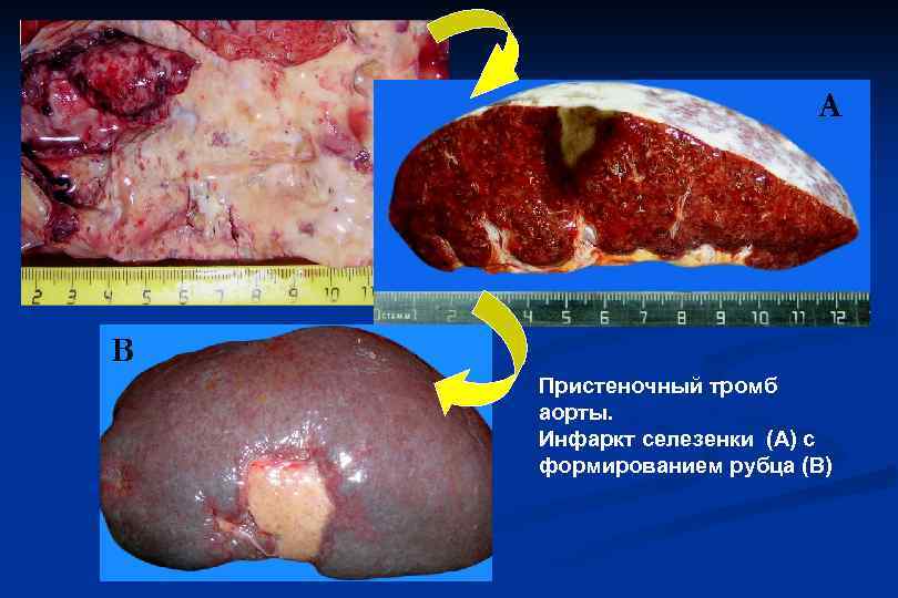  А В Пристеночный тромб аорты. Инфаркт селезенки (А) с формированием рубца (В) 