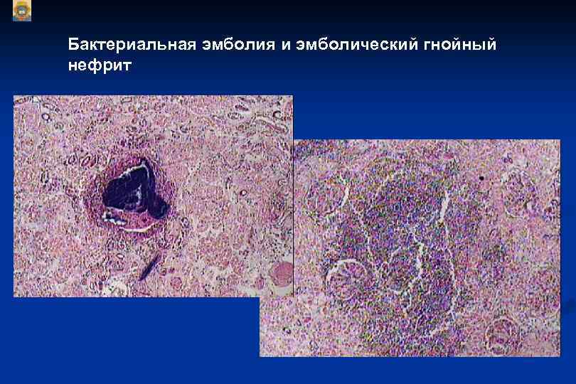 Бактериальная эмболия и эмболический гнойный нефрит 