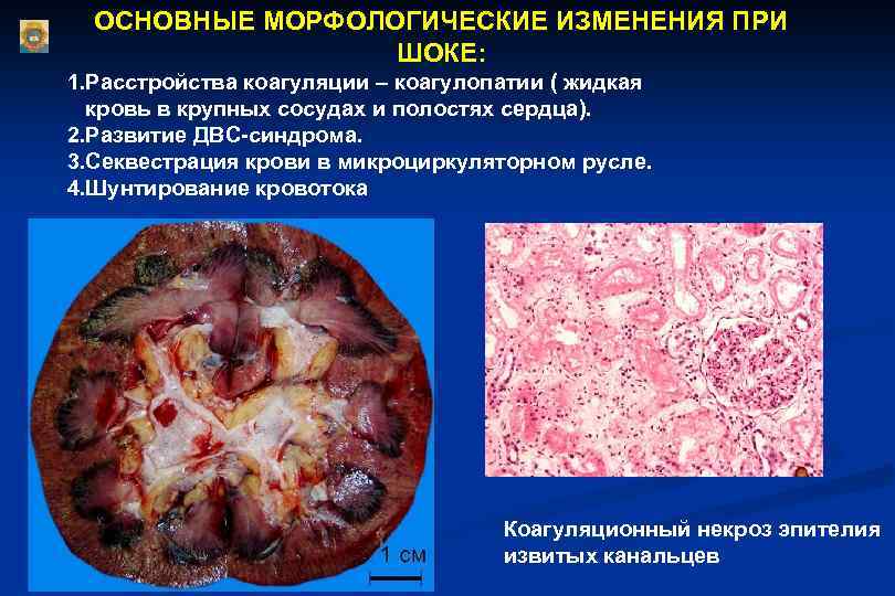  ОСНОВНЫЕ МОРФОЛОГИЧЕСКИЕ ИЗМЕНЕНИЯ ПРИ ШОКЕ: 1. Расстройства коагуляции – коагулопатии ( жидкая кровь