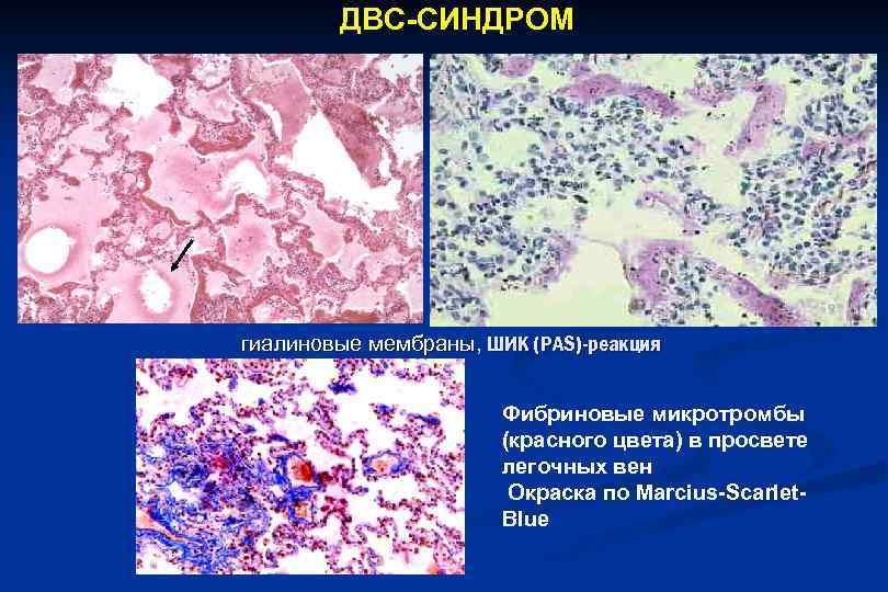  ДВС-СИНДРОМ гиалиновые мембраны, ШИК (PAS)-реакция Фибриновые микротромбы (красного цвета) в просвете легочных вен