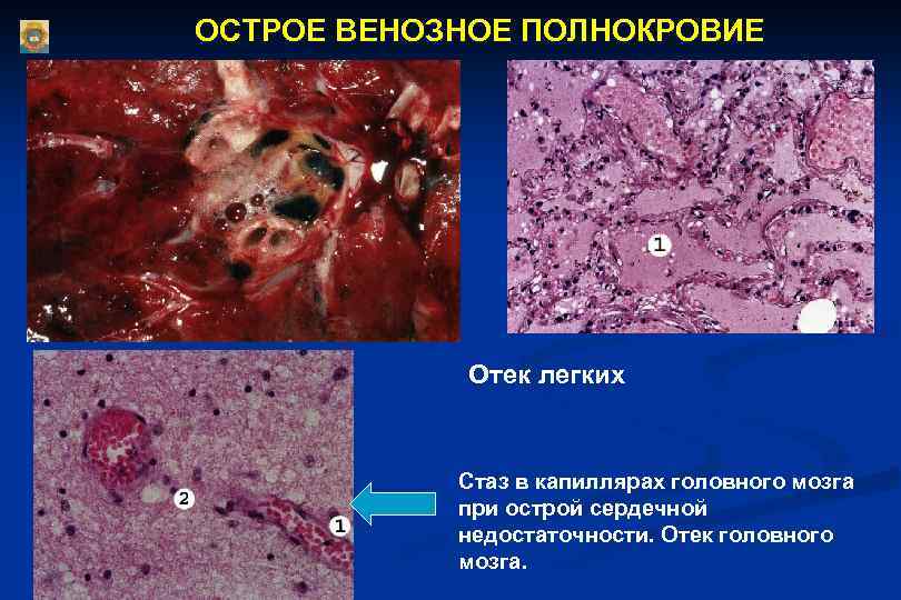 ОСТРОЕ ВЕНОЗНОЕ ПОЛНОКРОВИЕ Отек легких Стаз в капиллярах головного мозга при острой сердечной недостаточности.