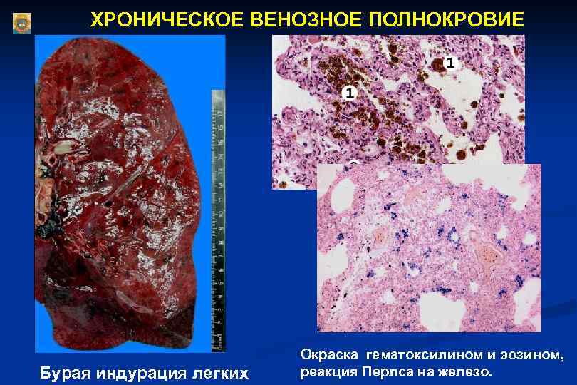  ХРОНИЧЕСКОЕ ВЕНОЗНОЕ ПОЛНОКРОВИЕ Окраска гематоксилином и эозином, Бурая индурация легких реакция Перлса на