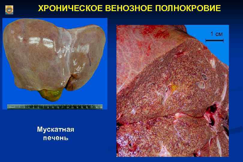 ХРОНИЧЕСКОЕ ВЕНОЗНОЕ ПОЛНОКРОВИЕ Мускатная печень 