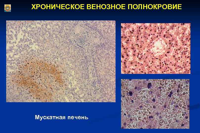 Хроническое венозное. Венозное полнокровие печени. Полнокровие мускатной печени. Хроническое венозное полнокровие печени. Хроническое венозное полнокровие печени микропрепарат.