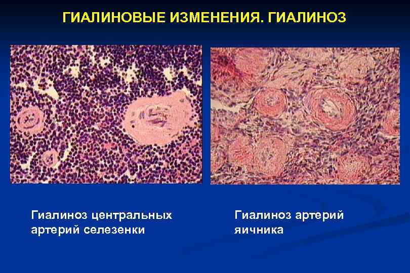 Гиалиноз относится к. Гиалиноз сосудов яичника. Гиалиноз стенок сосудов. Гиалиноз капсулы и артерий селезенки. Кисты яичника гиалин микропрепарат.