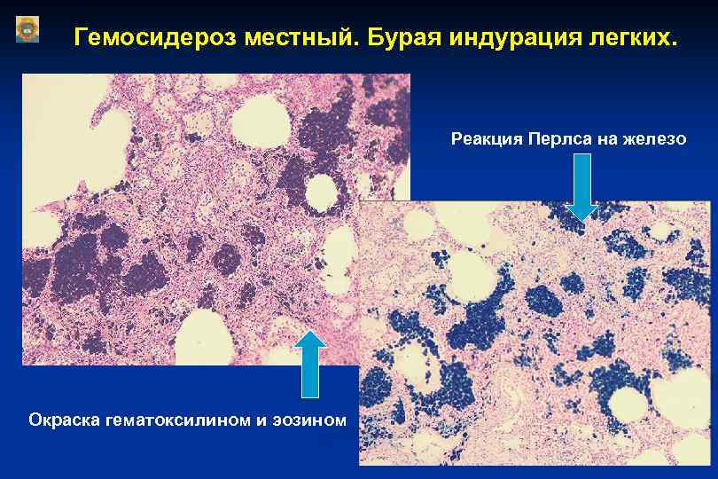 Легкие реакции. Бурая индурация легкого реакция Перлса. Гемосидероз (бурая индурация). Бурая индурация легких гематоксилин эозин. Бурая индурация легкого. Окраска: гематоксилином и эозином.