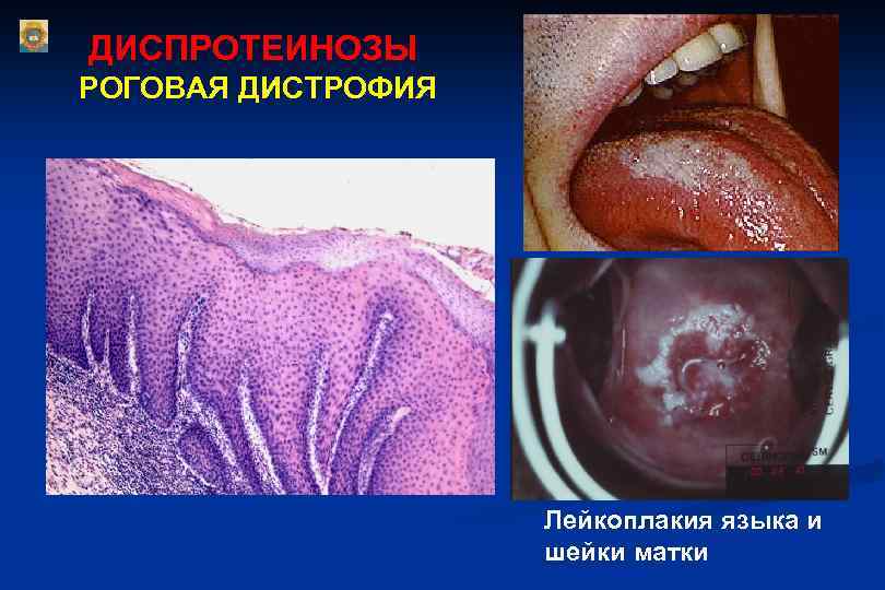 ДИСПРОТЕИНОЗЫ РОГОВАЯ ДИСТРОФИЯ Лейкоплакия языка и шейки матки 