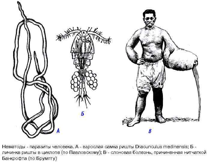 Нематоды - паразиты человека. А - взрослая самка ришты Dracunculus medinensis; Б личинка ришты