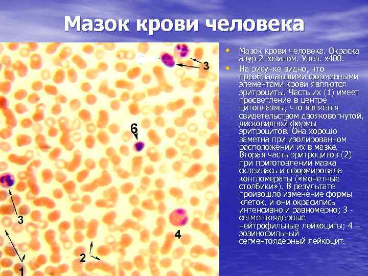 Мазок крови человека • Мазок крови человека. Окраска азур-2 эозином. Увел. х400. • На