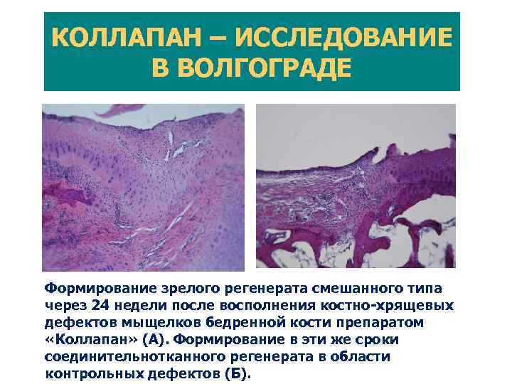 Схема трансплантации аутогенного суставного хряща на синтетической матрице (CAIS) [Bruder S. P. , 2012].