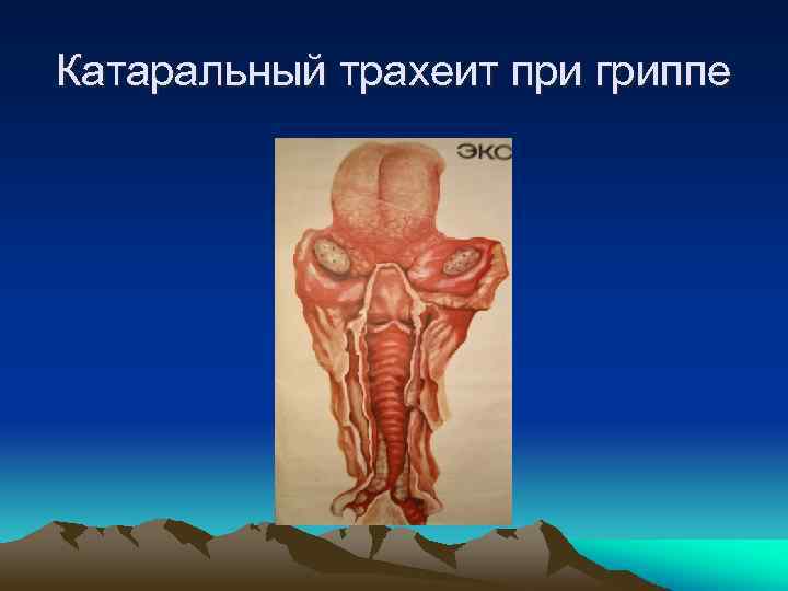 Катаральный трахеит при гриппе 