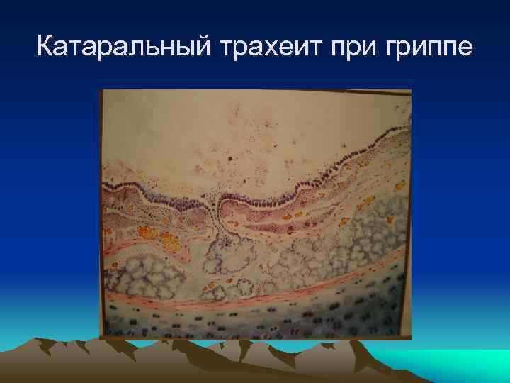 Катаральный трахеит при гриппе 