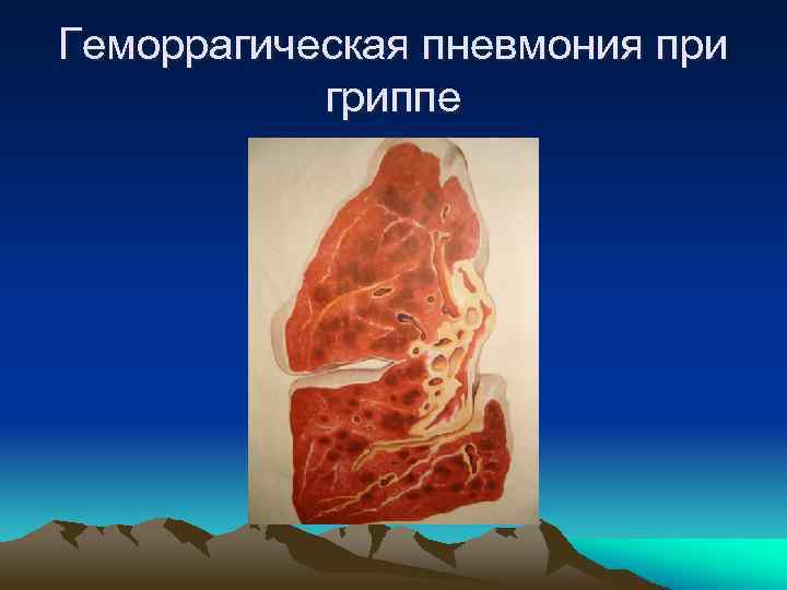 Геморрагическая пневмония при гриппе 