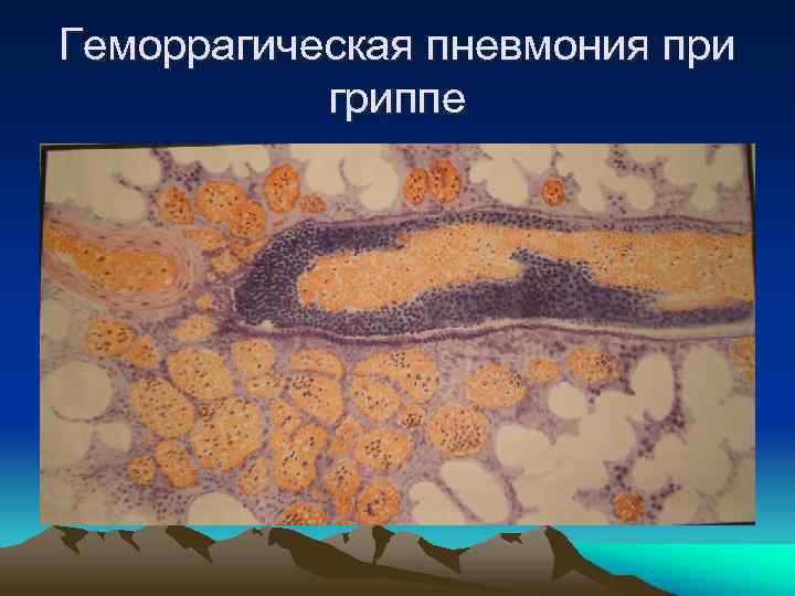 Геморрагическая пневмония при гриппе 
