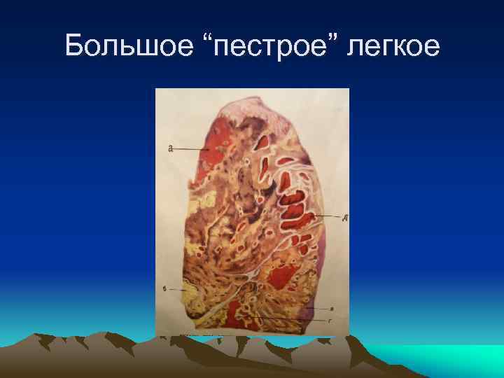 Большое “пестрое” легкое 