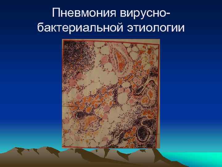 Пневмония вируснобактериальной этиологии 