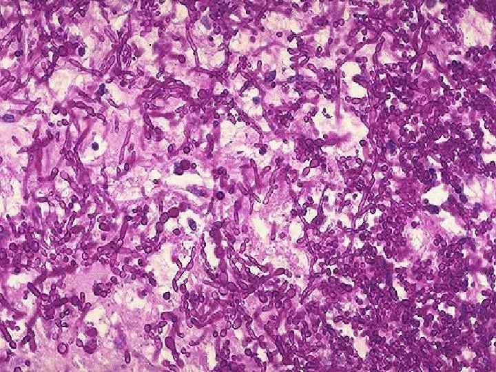 Candida albicans is seen here as an invasive process in the esophagus with PAS
