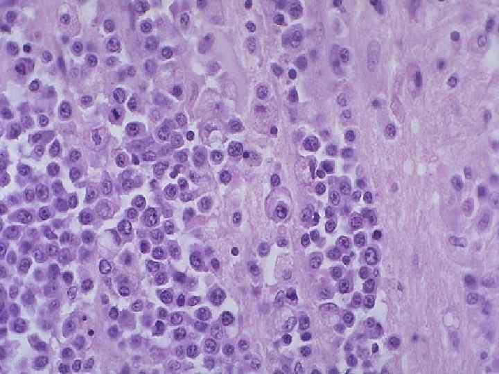 At high magnification, this non-Hodgkin's lymphoma infiltrating the cerebrum is composed of large lymphocytes