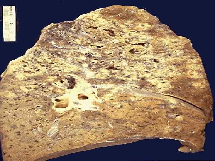 Mycobacterium tuberculosis infection of lung, with upper lung field granulomatous and cavitary disease shown
