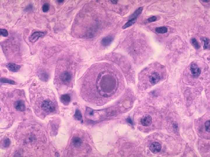 CMV can often be disseminated and involve a variety of organs, though the degree