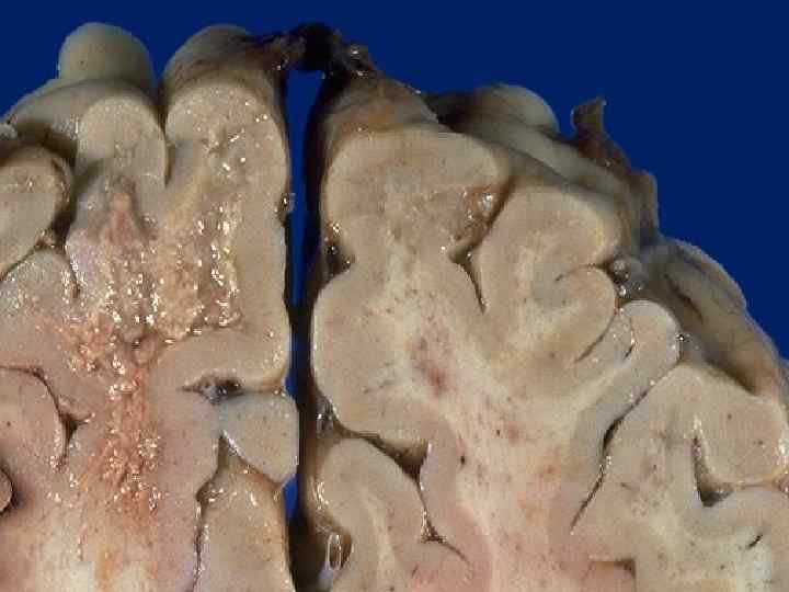 Progressive multifocal leukoencephalopathy (PML) appears grossly as irregular areas of granularity in white matter