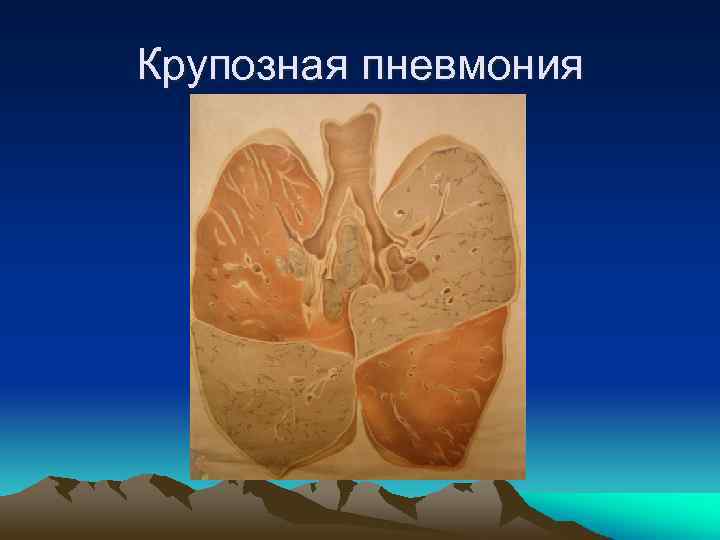 Крупозная пневмония 