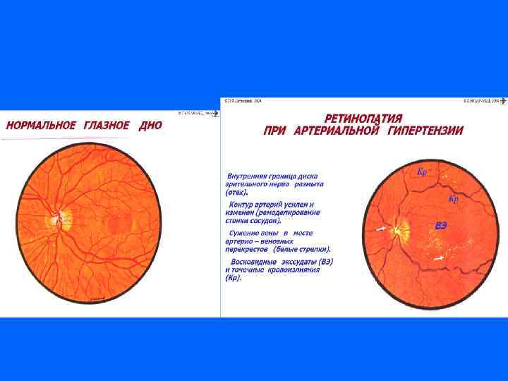 гипертензия нормотензия 