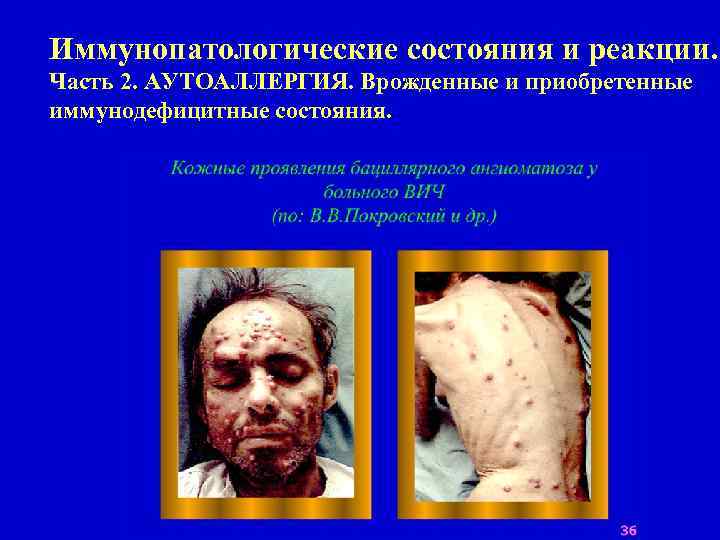 Иммунопатологические состояния и реакции. Часть 2. АУТОАЛЛЕРГИЯ. Врожденные и приобретенные иммунодефицитные состояния. 