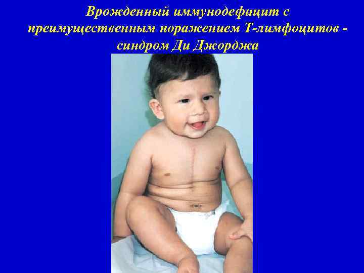 Врожденный иммунодефицит с преимущественным поражением Т-лимфоцитов синдром Ди Джорджа 