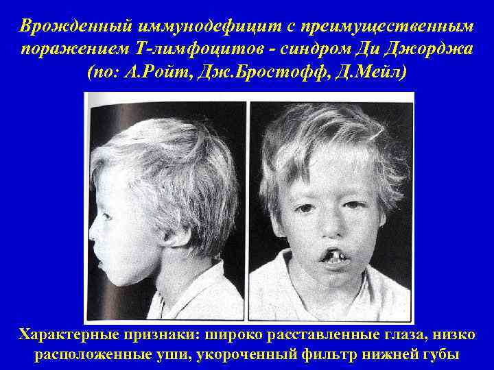 Врожденный иммунодефицит с преимущественным поражением Т-лимфоцитов - синдром Ди Джорджа (по: А. Ройт, Дж.