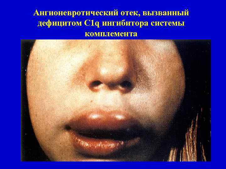 Ангионевротический отек, вызванный дефицитом С 1 q ингибитора системы комплемента 