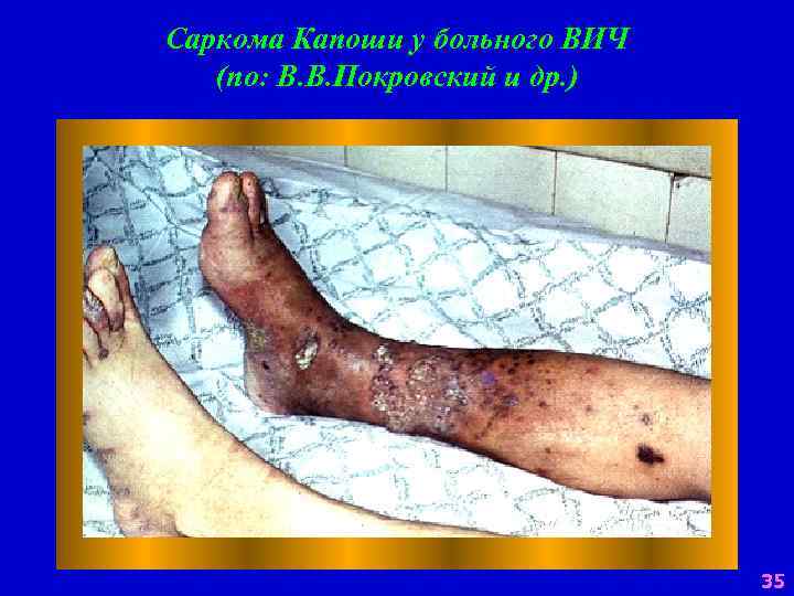 Саркома Капоши у больного ВИЧ (по: В. В. Покровский и др. ) 35 