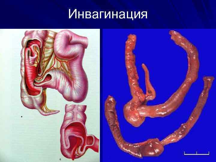 Инвагинация 